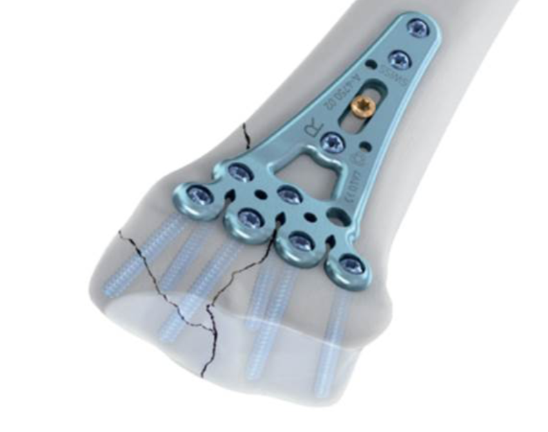 AR for bone fragment reconstruction, a tool for surgeons