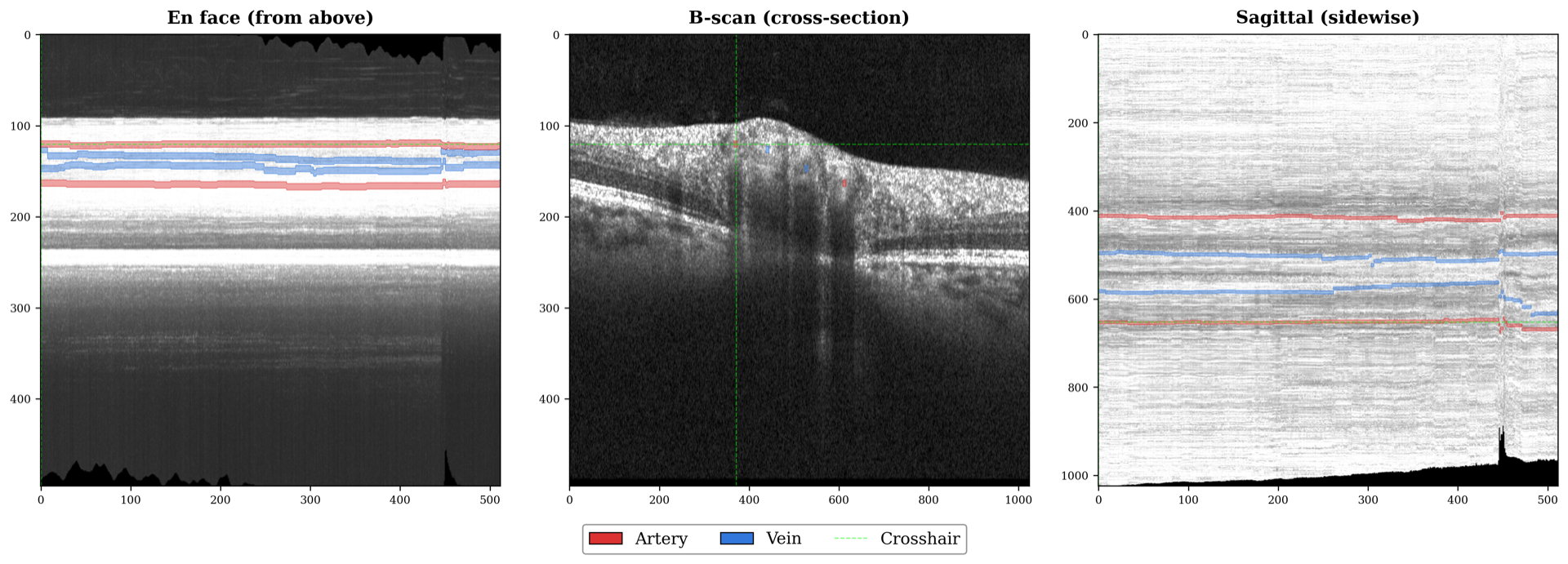 Orthogonal views of an OCT volume with artery and vein annotations
