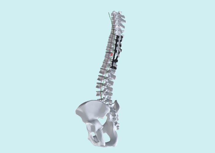 3D UI/UX für die Planung bei der Skoliose-Chirurgie