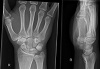 Multimodale Modellierung von Handgelenksfrakturen