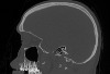 Image-to-Image translation for medical images with diffusion models