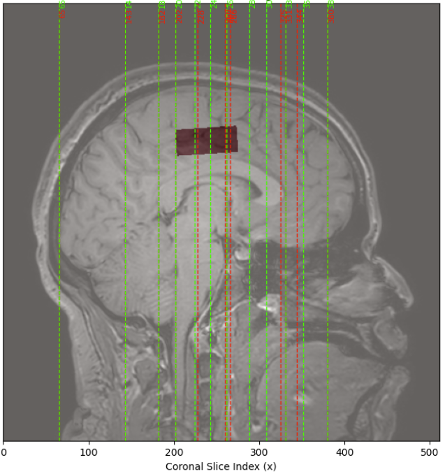 Zugewiesene Positionen des Mappings im MRI